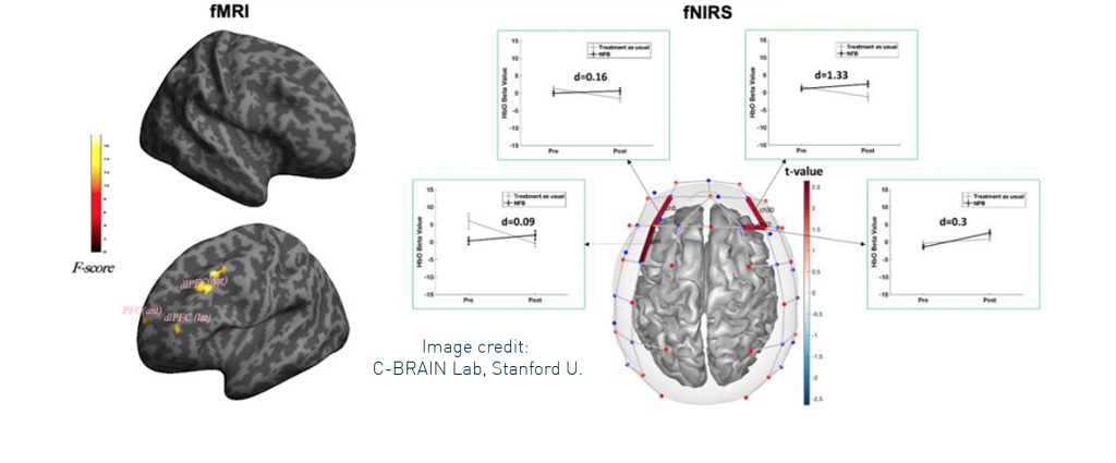 Revolutionizing ADHD Treatment Through Neuromonitoring Guided Working ...